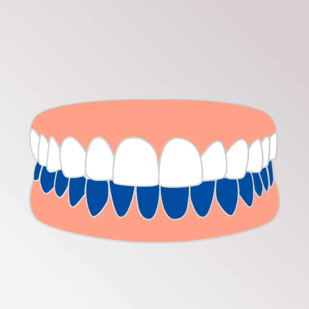 Нижняя челюсть