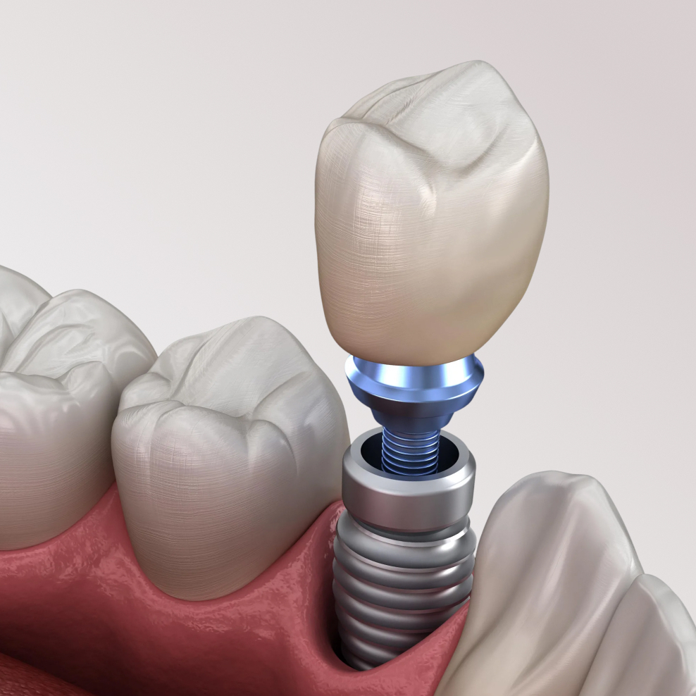 Имплантация зубов