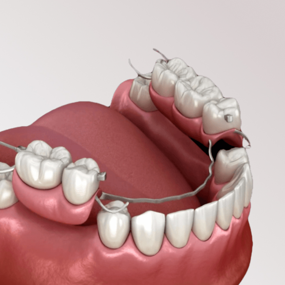 Съемный протез