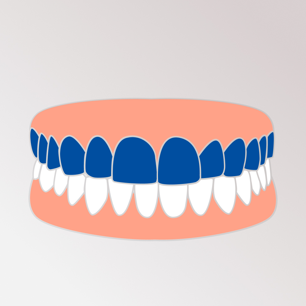 Верхняя челюсть